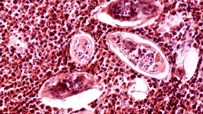 Histopathology of Schistosomiasis haematobia by Dr. Edwin P. Ewing, Jr. (CDC), [Public Domain], via wikimedia.or