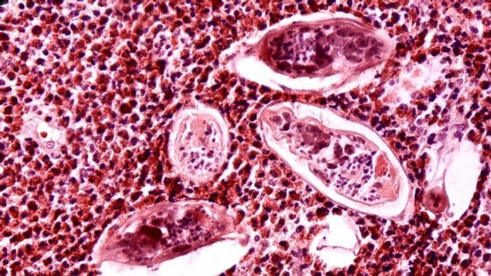 Histopathology of Schistosomiasis haematobia by Dr. Edwin P. Ewing, Jr. (CDC), [Public Domain], via wikimedia.org